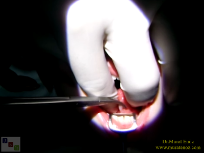 Thermal welding ile dil bağı ameliyatı -  Tongue tie release surgery with thermal welding device - Lingual frenectomy operation with thermal welding device - Bloodless and knifeless tongue tie release surgery - Bloodless lingual frenectomy with with thermal welding – Tongue tie treatment in İstanbul, Turkey