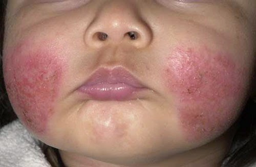 eczema, atopic dermatitis, KL, PJ