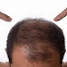 Best Hair Loss Fighting Foods