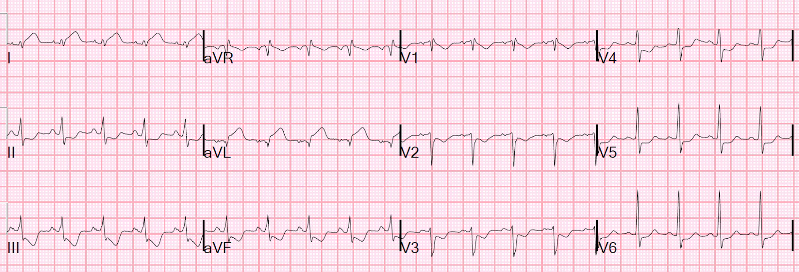 Dr. Smith&#39;s ECG Blog: A Middle-Aged Woman with 3 days of Chest pain and Posterolateral Injury on ...