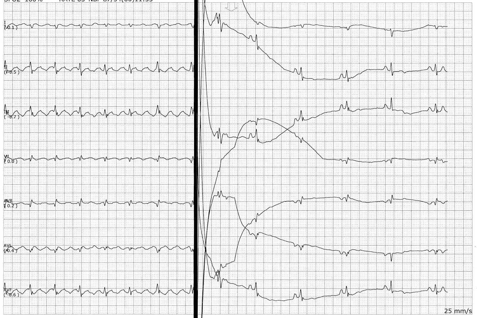 does atrial flutter always turn into afib flutter does atrial flutter always turn into afib flutter