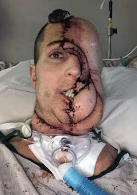 C Man who lost half his face to melon-size cancerous tumour gets Terminator-style transplant built by genius surgeon (graphic photos)