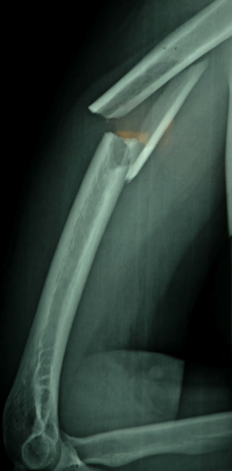 O R T O C R I T I C A Fractura expuesta humeral con lesion del nervio radial O R T O C R I T I C A Fractura expuesta humeral con lesion del nervio radial