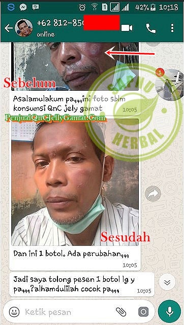 Cara Mengobati Iritasi Pada Bibir Vagina Secara Alami Terbukti Mujarab ~ TESTIMONI QNC JELLY GAMAT Cara Mengobati Iritasi Pada Bibir Vagina Secara Alami Terbukti Mujarab ~ TESTIMONI QNC JELLY GAMAT