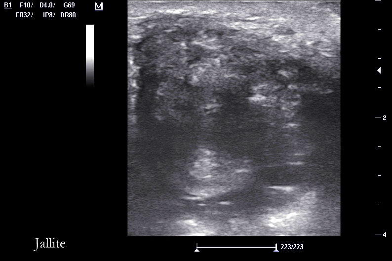 Tumor Muscular
