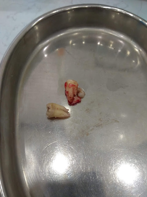 Chi phí nhổ răng số 8 và quy trình nhổ răng số 8 tại viện răng hàm mặt trung ương, Hà Nội Chi phí nhổ răng số 8 và quy trình nhổ răng số 8 tại viện răng hàm mặt trung ương, Hà Nội