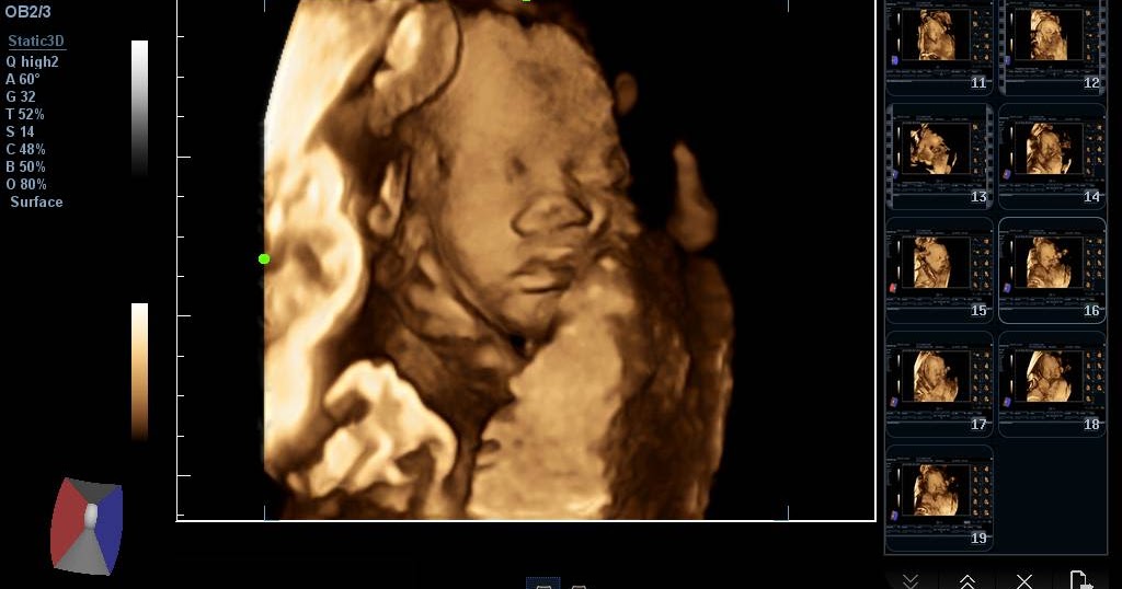 Klinik Scan Baby Melaka Apa beza 2D, 3D, 4D, 5D & 6D Ultrasound Scan