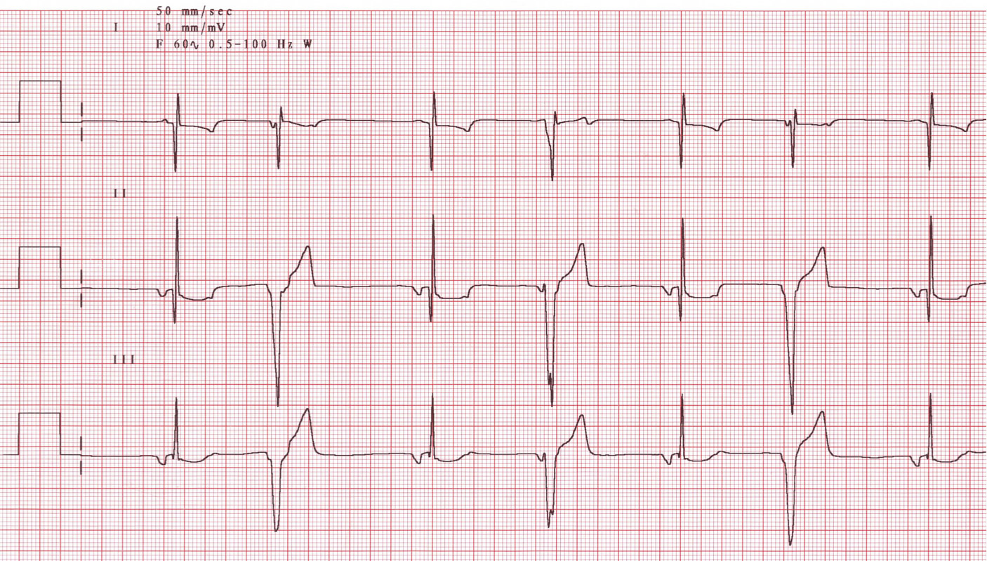 Схематично нарисуйте экг здорового человека. Электрокардиограмма здорового человека. Кардиограмма сердца здорового человека. ЭКГ здорового человека и больного. ЭКГ здорового сердца.