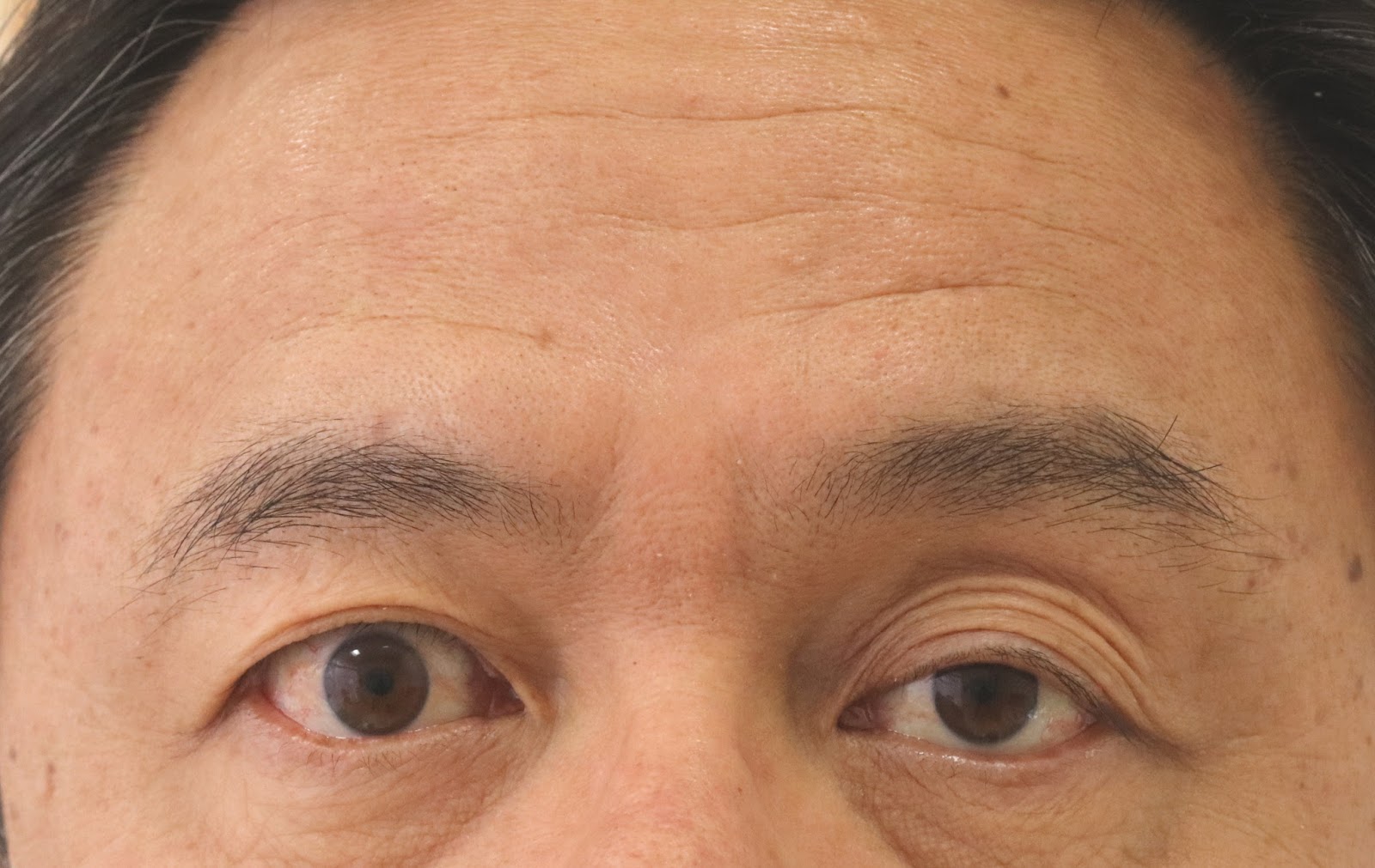まぶたのくぼみを治す －眼瞼下垂手術の応用－ - SSクリニック - 皮膚科・美容外科 - 名古屋市中区