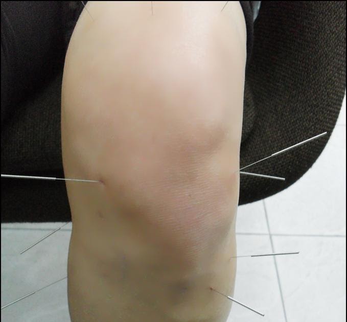 TCM News Best TCM Doctors Treat Knee Pain TCM Acupuncture