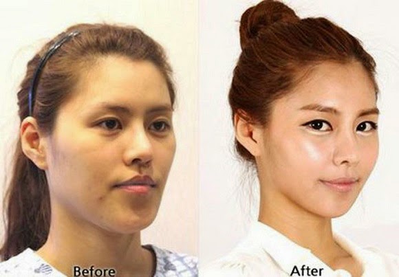 Plastik korea wajah orang operasi asli tanpa 7 Potret