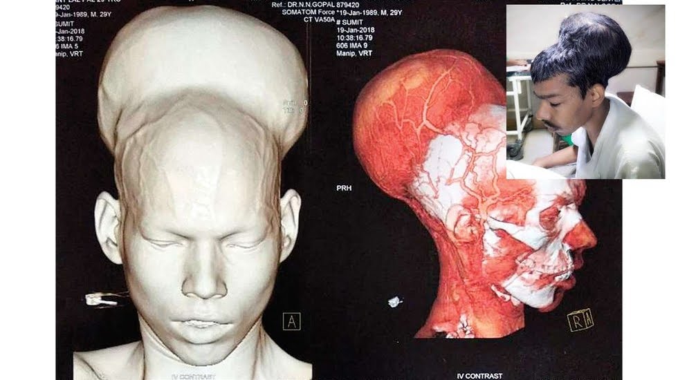 Incredibile: riescono ad asportare il più grande tumore al cervello nel mondo | Salute News
