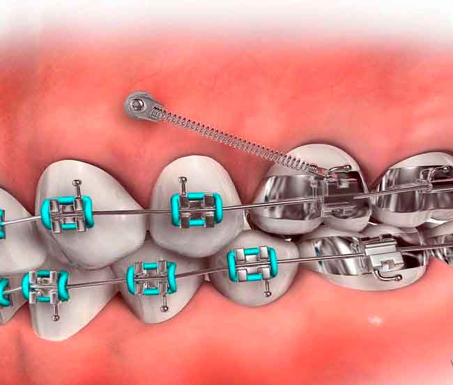 Miniscrews Clinical Application of ORTHODONTIC Directorio Odontológico