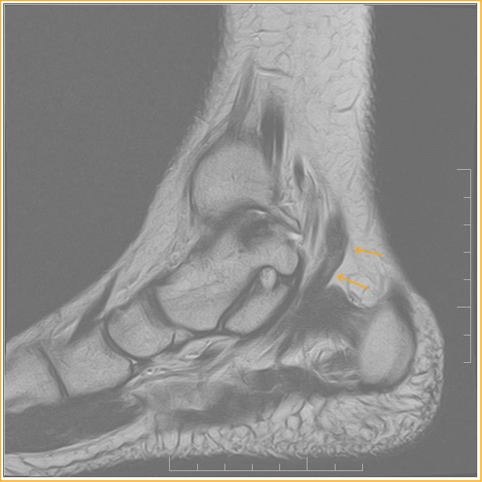 Flexor digitorum accessorius longusMRI Radiology Imaging