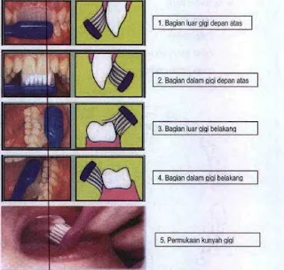 Cara/Langkah Menyikat Gigi