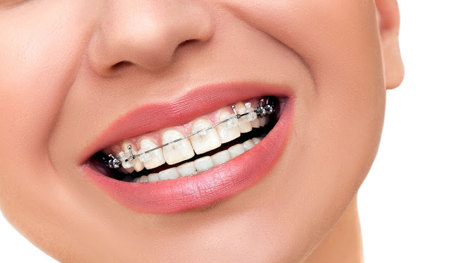 Perkiraan Biaya Pasang Behel Bagi Kamu yang Ingin Pasang Behel Gigi Perkiraan Biaya Pasang Behel Bagi Kamu yang Ingin Pasang Behel Gigi