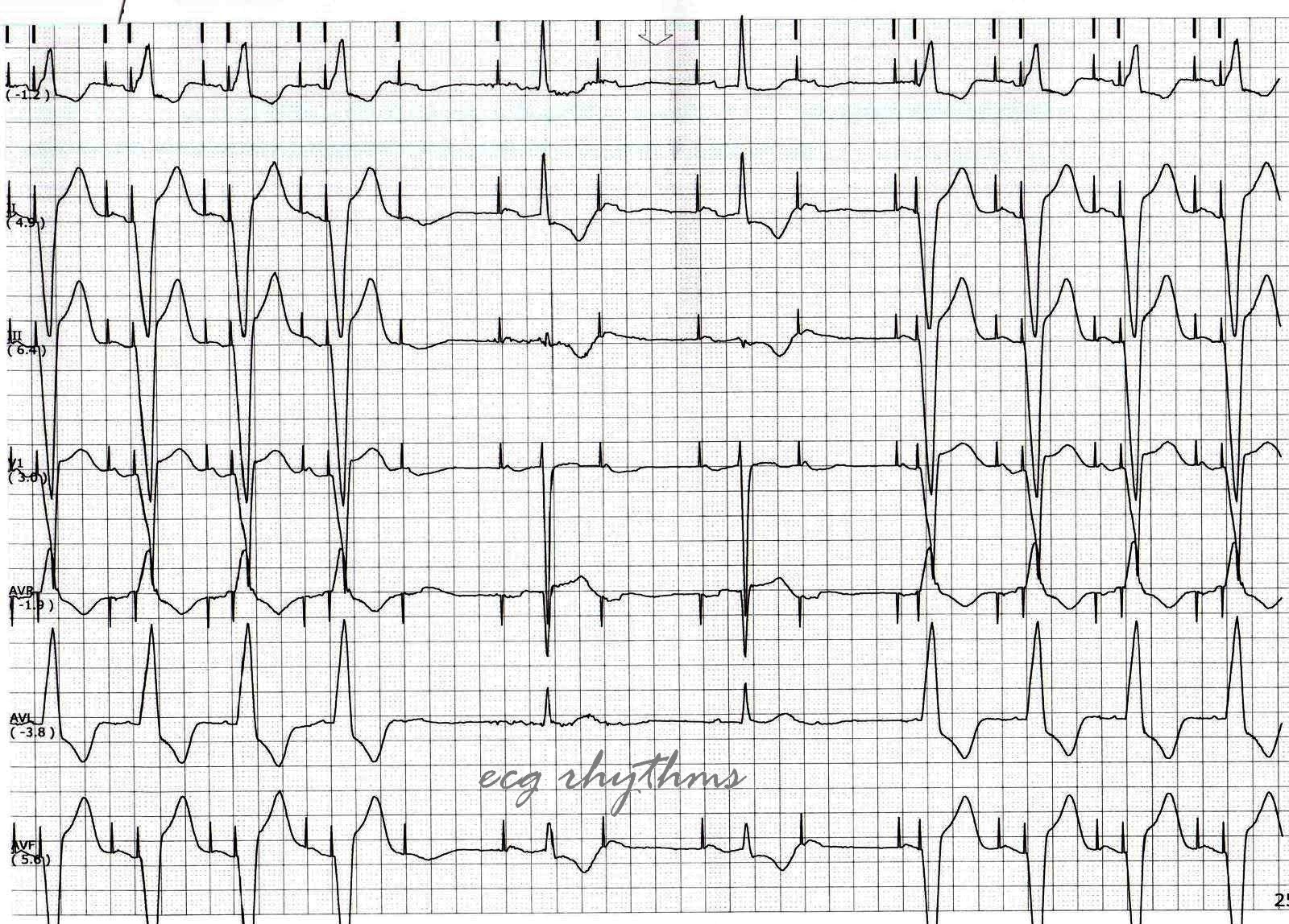 ECG Rhythms: ECG Practice