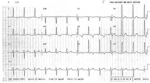 EKG elektrokardiografi elektrokardiogram ECG electrocardiography electrocardiogram kardiomiopati hipertrofik hypertrophic cardiomyopathy