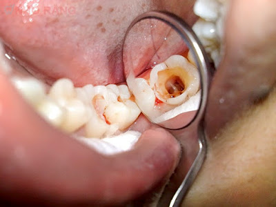Thời gian điều trị tủy răng bao lâu?