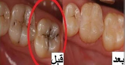 الأسنان البيضاء الصحية