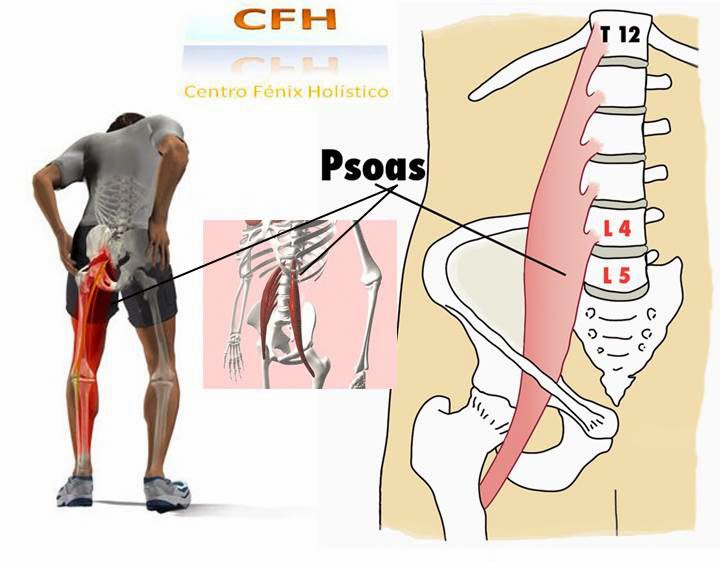 Dolor en el musculo psoas iliaco
