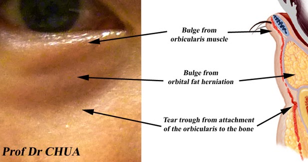 Eyelid Surgery By Prof Dr Cn Chua U8521 U9418 U80fd The Surface Anatomy