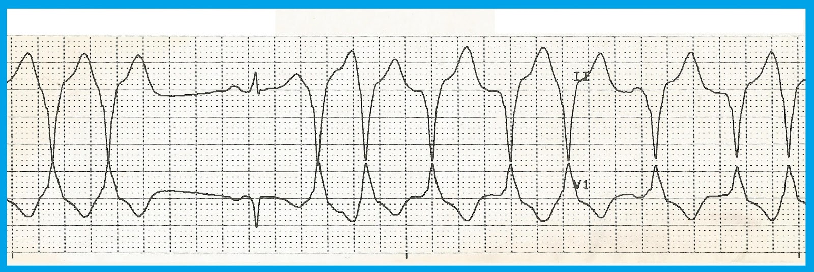 Float Nurse EKG Rhythm Strip Quiz 172