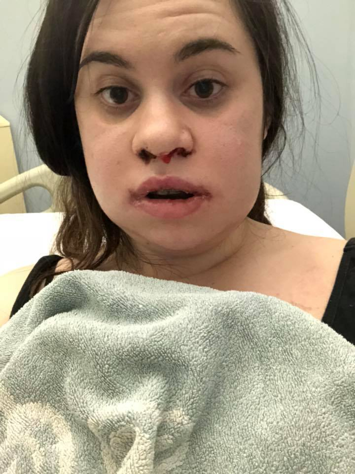 Double Jaw Surgery The Recovery
