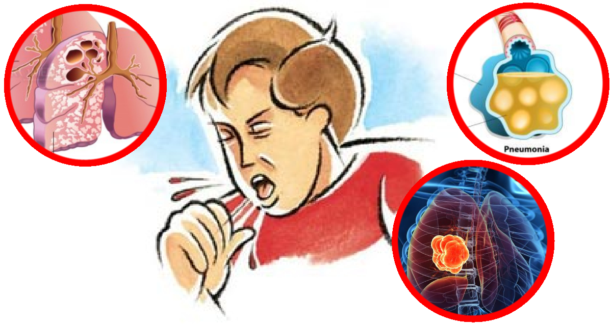 Как избавиться оттмакроты. Кровохоркаеие туберкулез. Накопление мокроты в бронхах. Кашель с мокротой форум. Мокрый кашель.