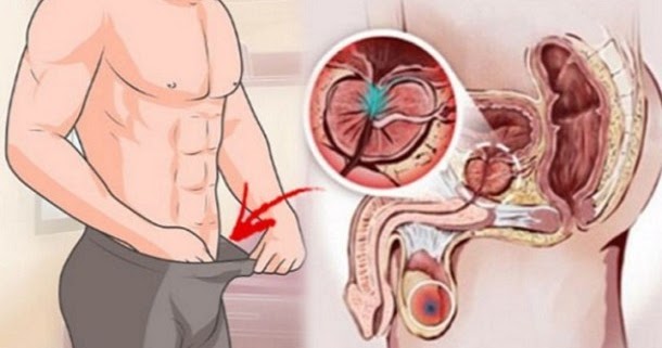 symptomen prostaatcarcinoom