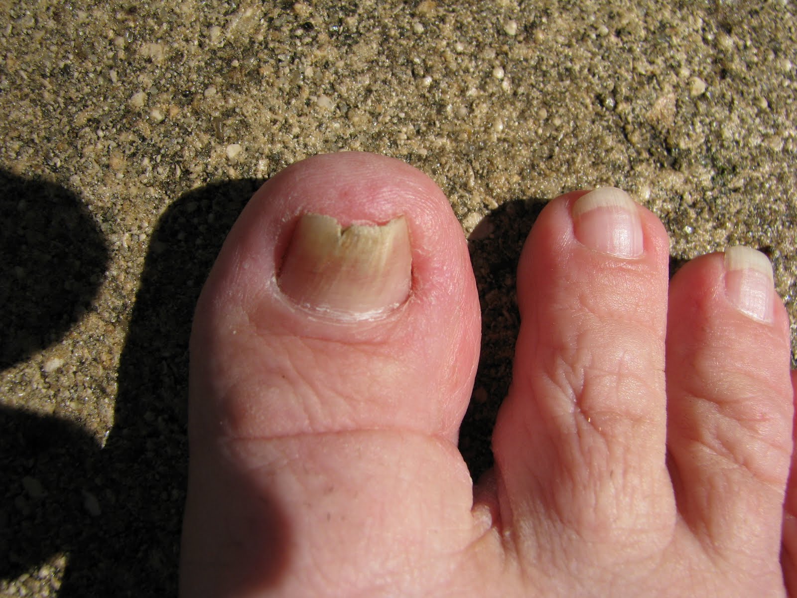 Love Country Living Toenail Fungus Day 1