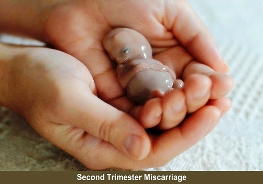 Second Trimester Miscarriage