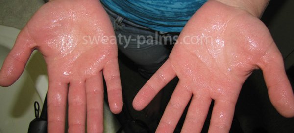 Sweaty palm in medical examination