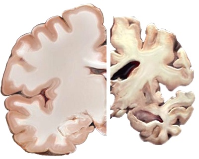 Sammenligning af sund og Alzheimers hjerne