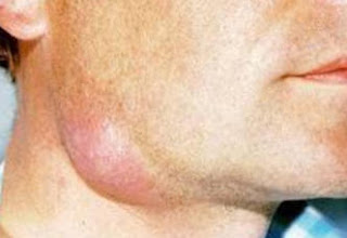 abscesses and cellulitis of the head and neck