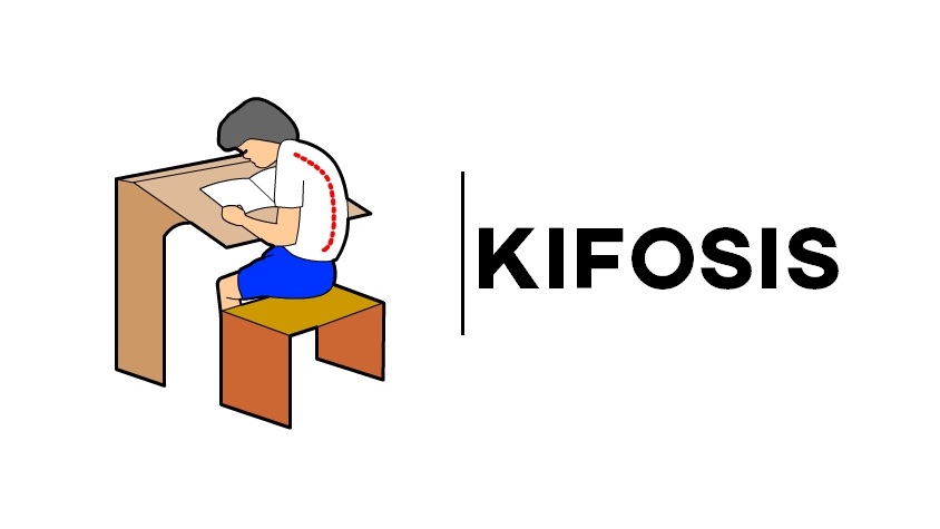 Pengertian Kifosis Dan Penyebabnya Cari Tahu Habibullah