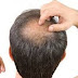 Berapa jumlah helai rambut di kepala Anda serta berapa yang rontok setiap hari?