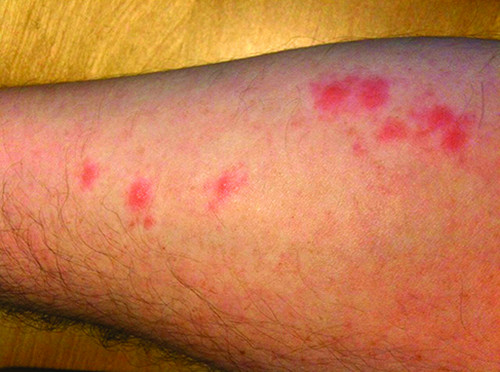 Bed Bug Rash Pictures Medical Pictures And Images 2023 Updated