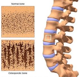 Obat Osteoporosis Di Apotik