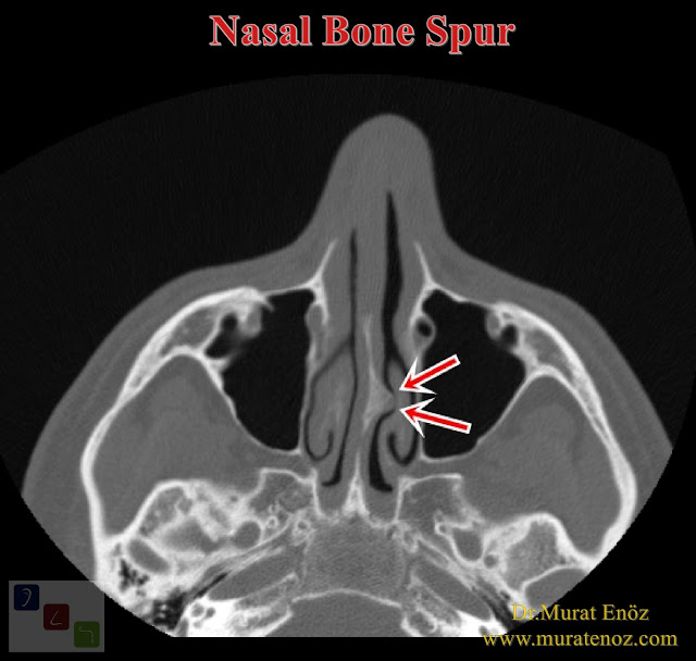 Ossified Overhang (Osteophyte) In The Nose That Can Cause Atypical