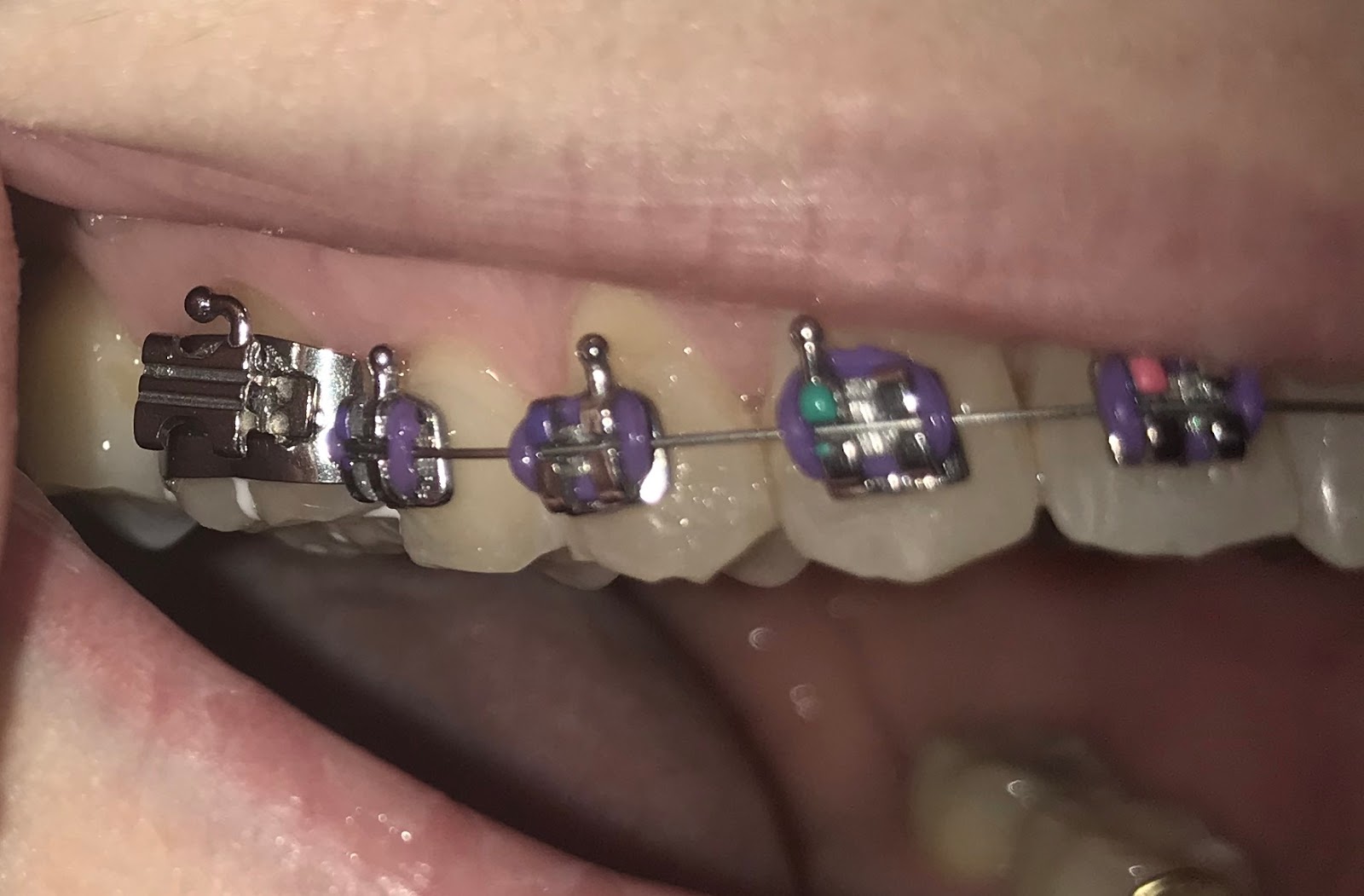 Sarah Says... Day 15, 3 molar bands and metal spacers