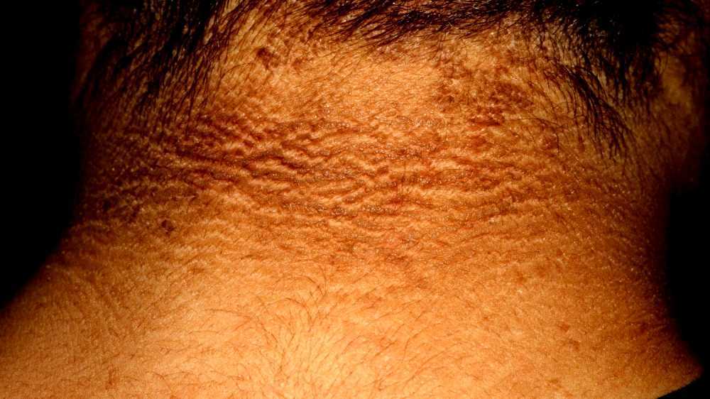 Acanthosis nigricans
