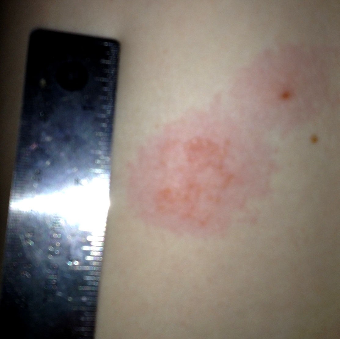 Life Alaskan Style snow (finally!) and a weird rash