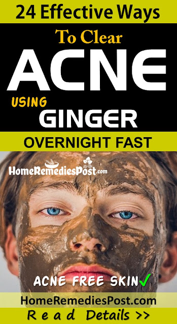 24 Ways To Use Ginger For Acne Treatment Naturally Fast Ginger For Acne, Ginger Acne, Ginger And Acne, Is Ginger Good For Acne, How To Use Ginger For Acne, How To Get Rid Of Acne, How To Get Rid Of Acne Fast, Home Remedies For Acne, Acne Treatment,