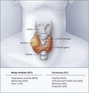 nodul tiroidian