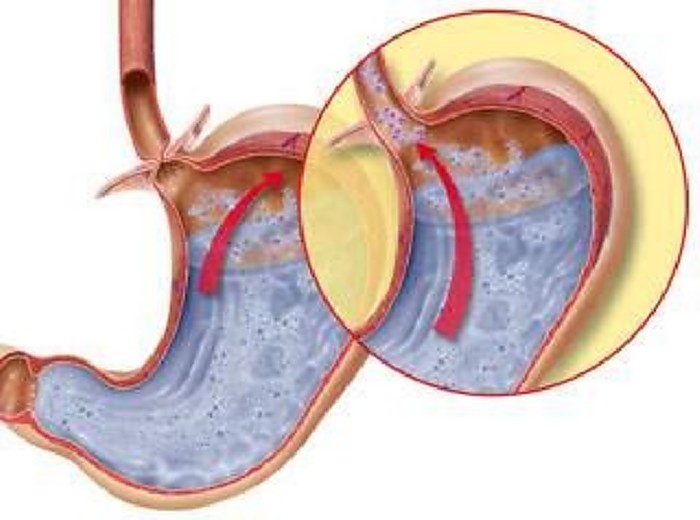 嗝氣嘔酸水胸悶 長期胃食道逆流 導致食道腺癌