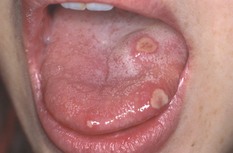 What is Stomatitis? - News-Medical.net