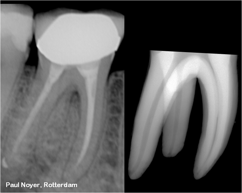 The Root Canal Anatomy Project Mandibular Second Molar Radix Entomolaris