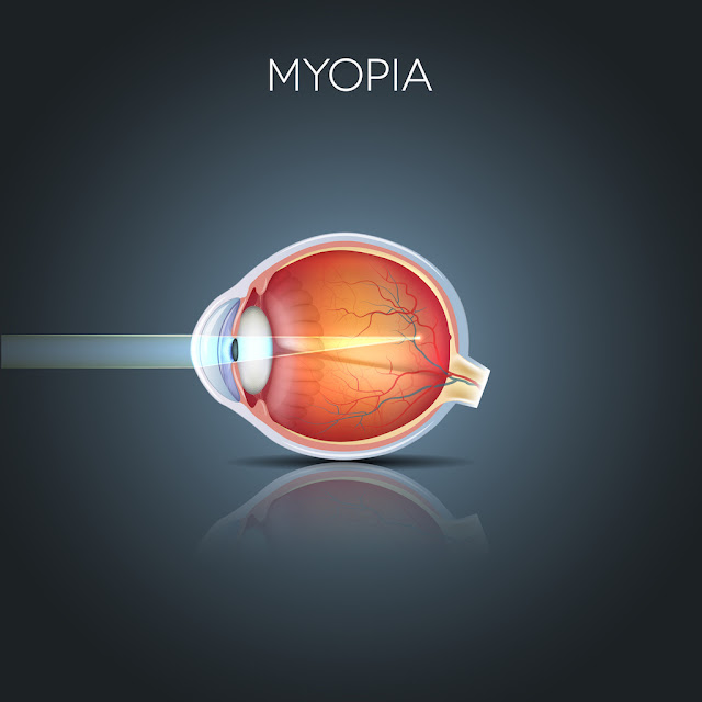 Myopia - The Hidden Truth
