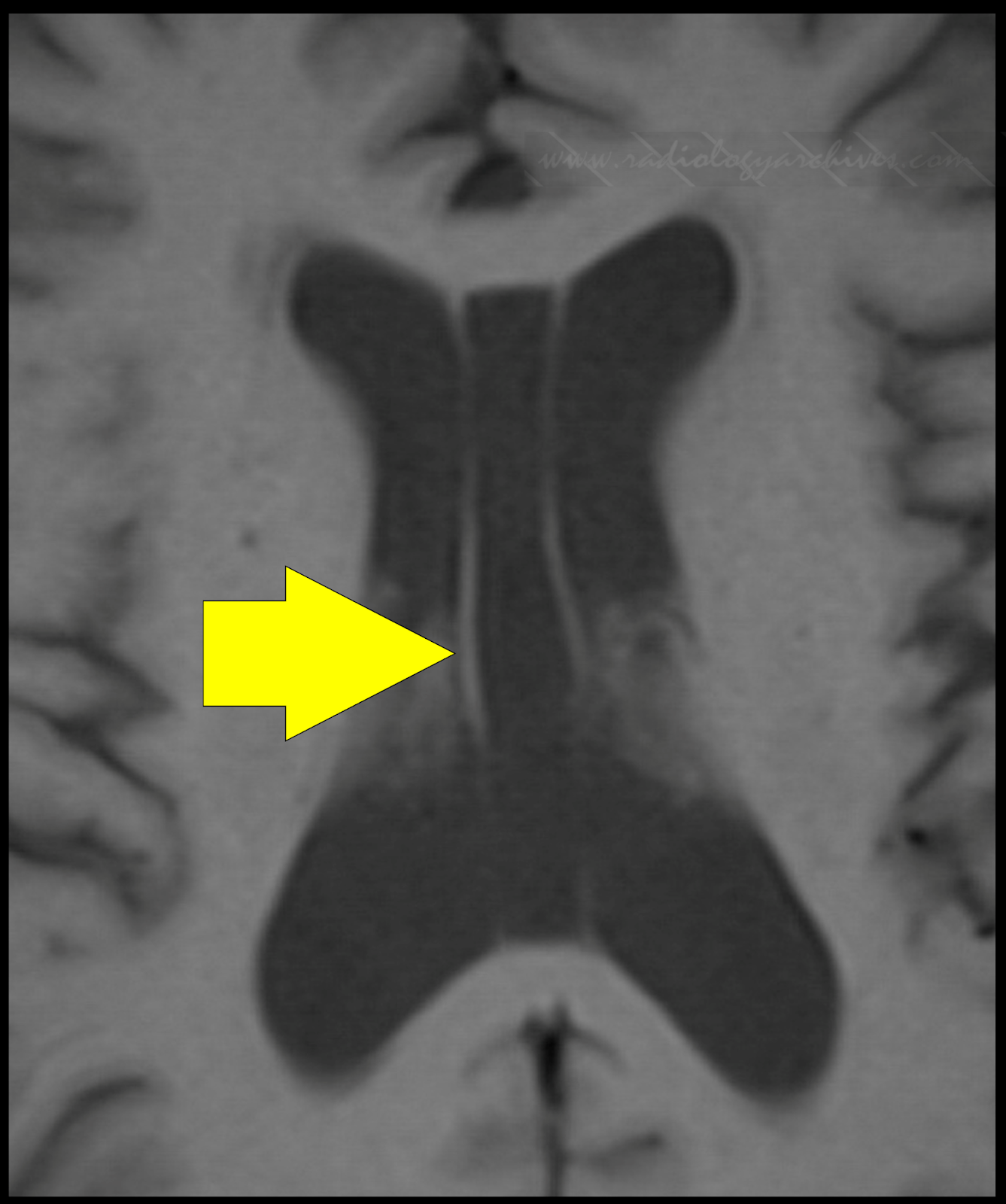 Radiology Archives Cavum Vergae